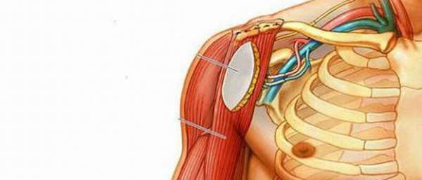 Плексопатия плечевого сустава